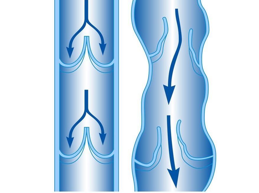 gezonde en spataderen