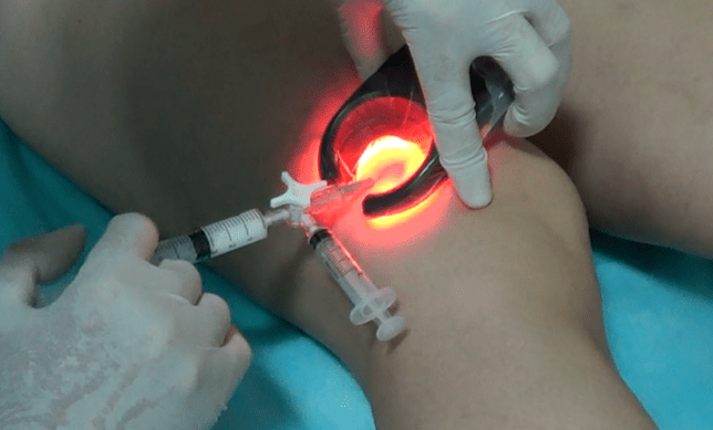 Sclerotherapie is een effectieve methode om spataderen in de benen te behandelen
